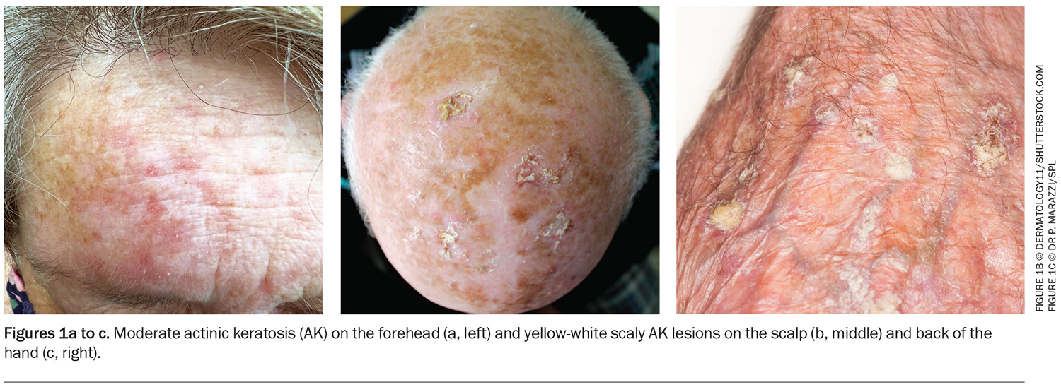 Actinic Keratosis An Update On Management Medicine Today